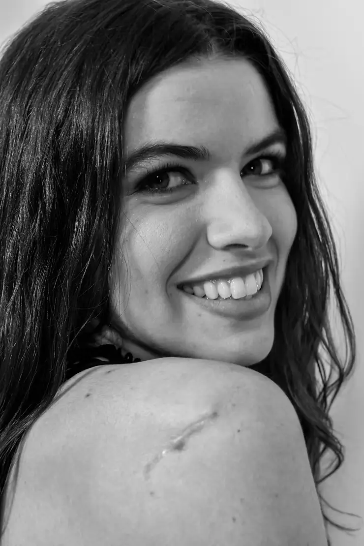 A black and white photograph of a woman with dark hair smiling. She is proudly displaying a scar on her shoulder